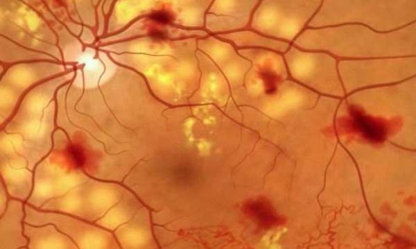 Диабетическая ретинопатия: что это такое, симптомы, лечение и стадии